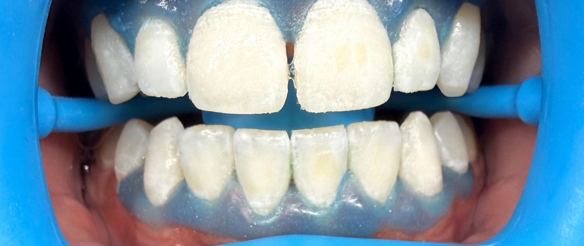 Case 01 whitening result — after