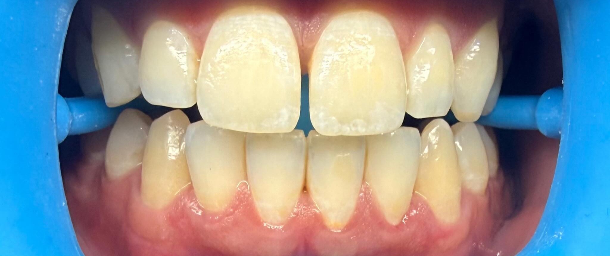 Case 01 whitening result — before