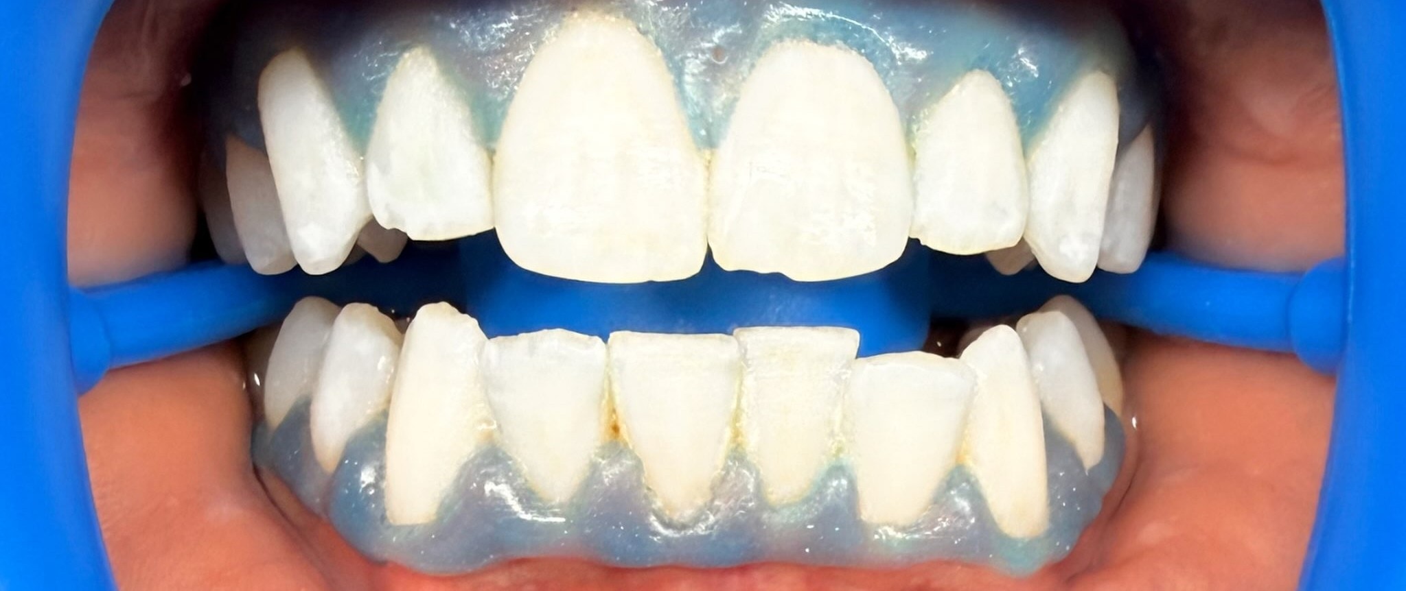 Case 02 whitening result — after