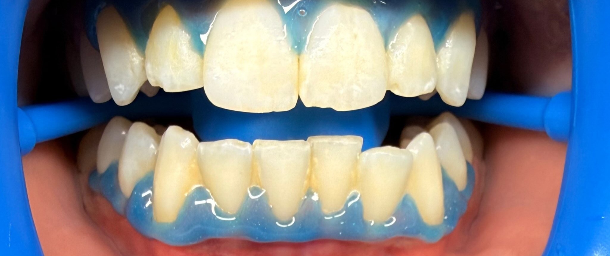 Case 02 whitening result — before