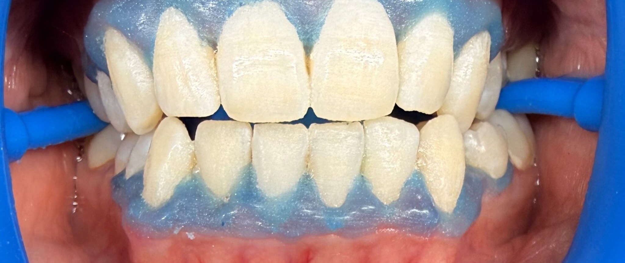 Case 03 whitening result — after