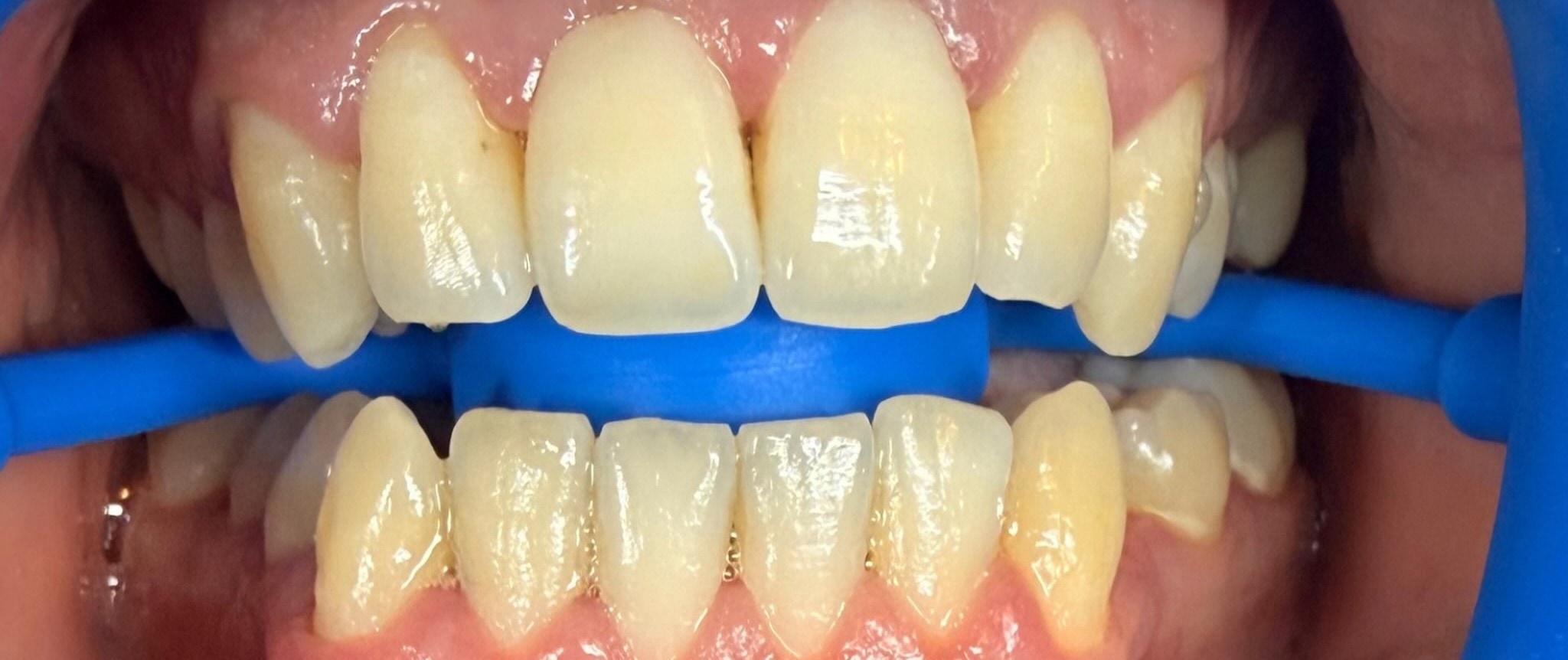 Case 03 whitening result — before