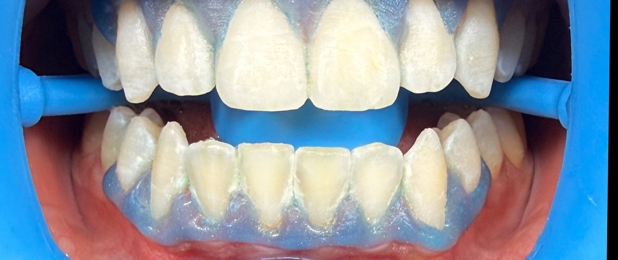 Case 05 whitening result — after