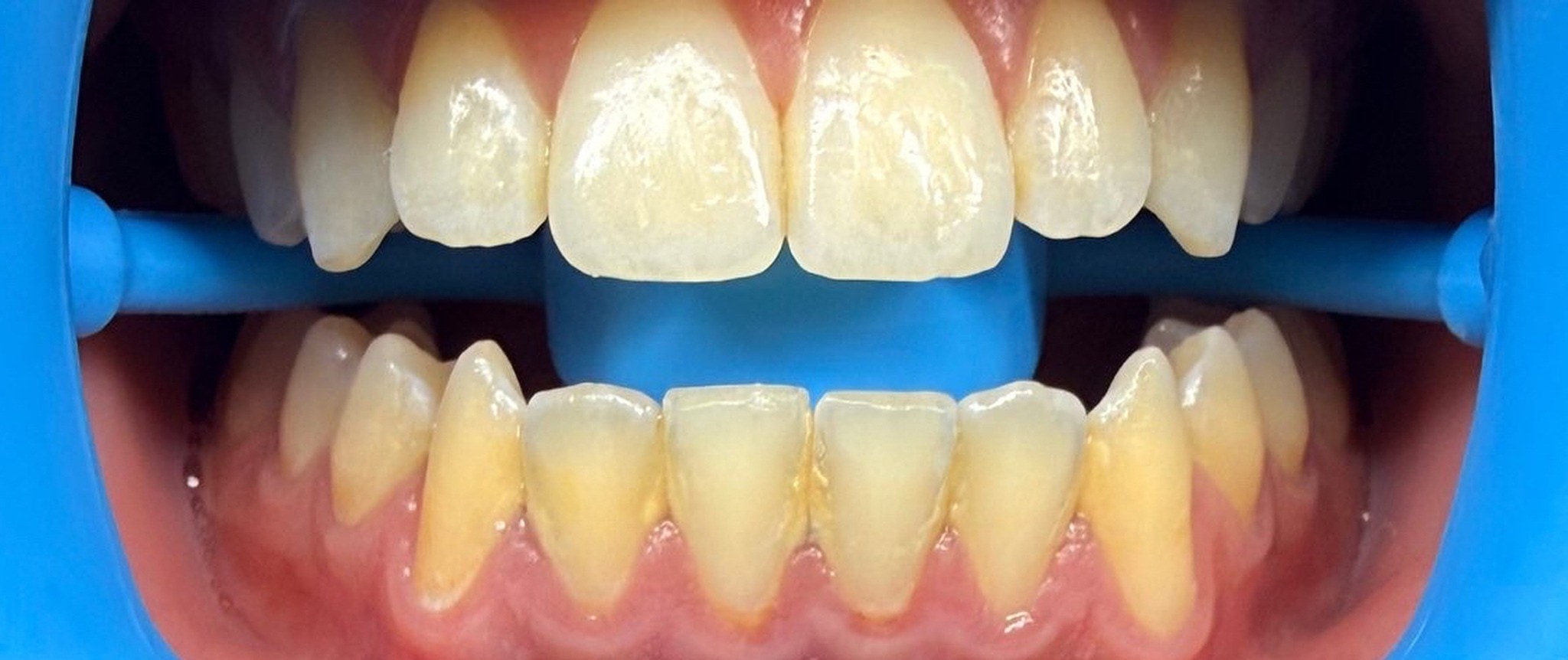 Case 05 whitening result — before